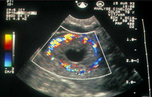 西安代孕第三代代孕_泰国试管婴儿移植后，做B超的各种作用你都了解吗？